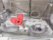 إنقاذ حياة طفلة حديثة الولادة بعملية دقيقة وتحويل مسار بالأمعاء بمستشفي طوخ المركزي