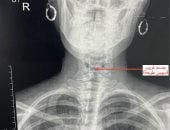 استخراج «دبوس طرحة» عالق في حنجرة فتاة بجراحة عاجلة بمستشفى بنها الجامعي