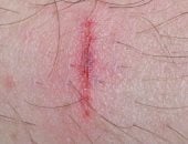 علماء يطورون ضمادة ذكية لعلاج الجروح تطلق مضادات حيوية عند وجود بكتيريا ضارة