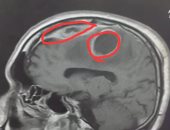 نجاح استئصال خراج بالمخ لشاب فى مستشفى دمياط العام