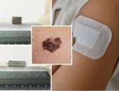 علماء يطورون لاصقة تنشط بالحرارة تقضي على سرطان الجلد الميلانينى بدون جراحة