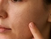وصفات طبيعية لعلاج مشكلة المسام الواسعة.. بخطوات سهلة وفعالة