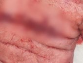 إنقاذ يد مريض من البتر بمستشفى دسوق بعد تعرضه لإصابة بالغة بآلة حادة