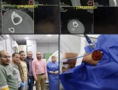نجاح عملية كي حراري لعلاج ورم عظمي حميد بمستشفيات جامعة بنى سويف