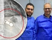 بلعت سوستة.. نجاح استخراج جسم معدني من معدة طفلة بمستشفى دسوق العام