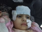 آخر تطورات حادث تعرض طفلة لهجوم أسد بالسيرك القومى فى العجوزة