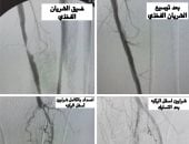 إنقاذ حياة 3 حالات بمستشفى القناطر الخيرية المركزى من بتر السيقان بجراحات عاجلة