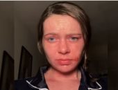 بسبب مرض مناعى نادر.. بريطانية تصاب بحروق بعد 15 ثانية فقط من تعرضها للشمس