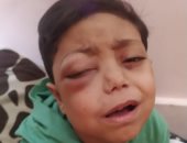 خالد عاشور طفل فلسطينى يواجه السرطان بعين تنزف ألما وحلم وحيد بالنجاة