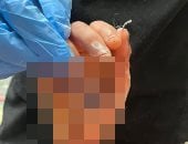 جراحة دقيقة تعيد الأمل.. إنقاذ فتاة من بتر كامل لليد بعد اعتداء بساطور بسوهاج