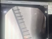 نجاح جراحة دقيقة لتثبيت كسر بالفخذ لطفل بمستشفى الفشن ببنى سويف