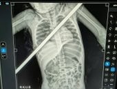 3 ساعات فى العمليات.. إنقاذ حياة طفلة اخترق سيخ حديد صدرها فى بنها الجامعى