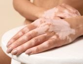 اليوم العالمى للبهاق.. 8 نصائح للتعايش معه دون التأثير على ثقتك بنفسك