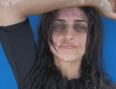 بعد أمير كرارة.. نجوم الفن يساندون شقيقته نسرين عقب إعلان إصابتها بالبهاق