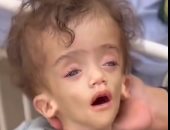 تحول لهيكل عظمي.. الرضيع الفلسطيني عصام فادي يصارع سوء التغذية في غزة 