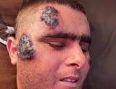 وسيم أبو يوسف يخوض معركة من أجل الحياة داخل غزة مع سرطان الدم ومرض كرون