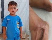 بيحلم يمشي تانى.. يزن علوان يخوض معركة مع الألم فى انتظار العلاج خارج غزة
