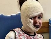الحروق سرقت طفولتها.. ريتال حلاوة تواجه الألم داخل خيمة لا تقيها حر الصيف في غزة.. ارتفاع درجات الحرارة يحول المعاناة إلى عذاب يومي يضاعف جراح طفلة لم تتجاوز السادسة.. وتحمل حلما مؤجلا لطفولة تستحق الحياة