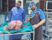 نجاح استئصال ورم مبيضي نادر يزن 24 كيلوجراما بمستشفى المنيا الجامعي