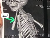 فريق جراحى بـ«بنها الجامعى» ينقذ حياة طفل سنة ونصف اخترق «مفك» رقبته