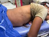 سيخ حديدى يخترق جسد شاب بعد سقوطه من برج تحت الإنشاء فى الغربية