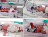 حالة نادرة للغاية.. أسترالية تنجب 4 توائم متطابقين بمشيمة واحدة