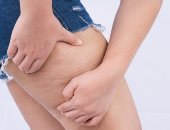 السيلوليت مع التقدم فى العمر.. لماذا يظهر وكيف يمكن تحسين مظهره؟