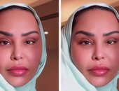 رحلة الفنانة أحلام مع التجميل تتواصل من الأنف إلى شد الوجه