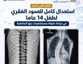 إنجاز طبى.. استعدال كامل للعمود الفقرى لطفل 14 عامًا بمستشفيات جامعة بنها
