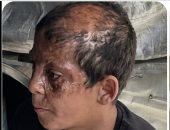 يحيى عوض طفل من غزة نجا من الموت والحرب تركت حروقا عميقة في رأسه وغيرت ملامحه إلى الأبد.. الطفل الفلسطينى يقف أمام المرآة بحثا عن صورته القديمة.. ويحلم بعلاج وزراعة شعر تعيدان إليه شيئا من طفولته وثقته بنفسه