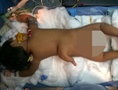 بالصور.. جراحة ناجحة لطفلة هندية ولدت بـ3 أرجل