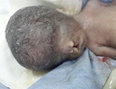 بالصور.. ولادة طفل بدون عيون وبشفة أرنبية وعيوب خلقية بالمخ والعمود الفقرى