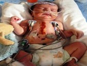 بالصور.. 3 عمليات جراحية خطرة لإنقاذ طفل أمريكى مولود بـ"نصف قلب"