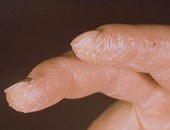 أخصائى جلدية: غسيل الصحون بمنظفات كيميائية يشكل خطورة صحية