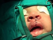 أستاذ جراحة أطفال: الشفة الأرنبية عيب خلقى يصيب واحدا من كل 2000 مولود