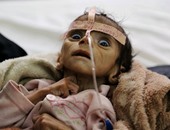 بعد عام من الحرب.. الجوع ينهش اليمن ويهدد حياة مئات الآلاف من الأطفال