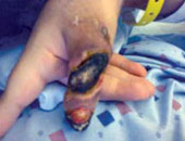 تلميذة تفقد أطراف أصابعها فى معمل المدرسة 