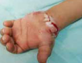 أطباء صينيون ينجحون فى إجراء جراحة لاعادة يد مبتورة لطفل فى السابعة
