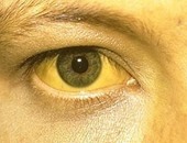 لون البول الداكن واصفرار العين والجلد من علامات إصابة الطفل بفيروس A
