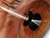 FDA تصدق على أول جهاز يزرع بالعين لعلاج مشاكل الرؤية عن قرب