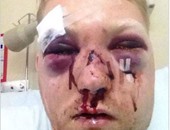 لاعب إنجليزى يطالب بمنع أسوار الملاعب بعد إصابته المروعة