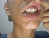 مدرس بالسويس يعتدى على طالب ويكسر أسنانه أثناء التجهيز لاحتفال تحرير سيناء