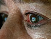 "جوجل" تستعد لزراعة كمبيوتر مصغر بالعين لتزويد ضعاف البصر بقوة خارقة