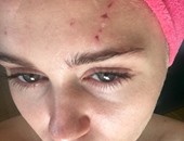 بالصور.. إصابة مايلى سايروس بجروح فى وجهها ورأسها وذراعها بسبب "قطة"