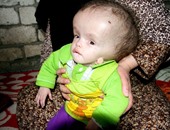 بالصور.. الطفلة فاطمة تعانى من مياه على المخ وتحتاج لجراحة بـ50 ألف جنيه