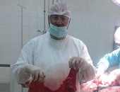 فريق طبى ينجح بإجراء جراحة نادرة لقاولون متضخم بمستشفى الإسماعيلية العام