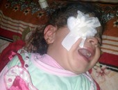 الطفلة "مِنّة" أصيبت بالعمى بسبب الإهمال الطبى فى الإسكندرية