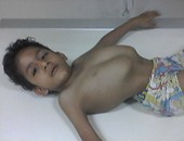 معاناة "محمد" ابن الـ 7سنوات بسبب التواء بالعمود الفقرى.. وعلاجه فى الخارج