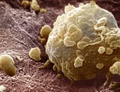 الصحة تكشف أسباب تكاثر الخلايا السرطانية فى الجسم.. اعرف التفاصيل