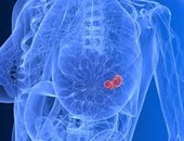 سرطان الثدى يتحدد بأشعة الماموجرام المقطعى ثلاثى الأبعاد